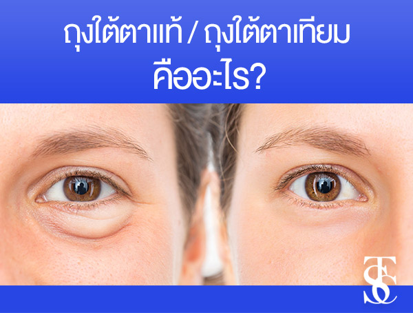 eyebagtype2