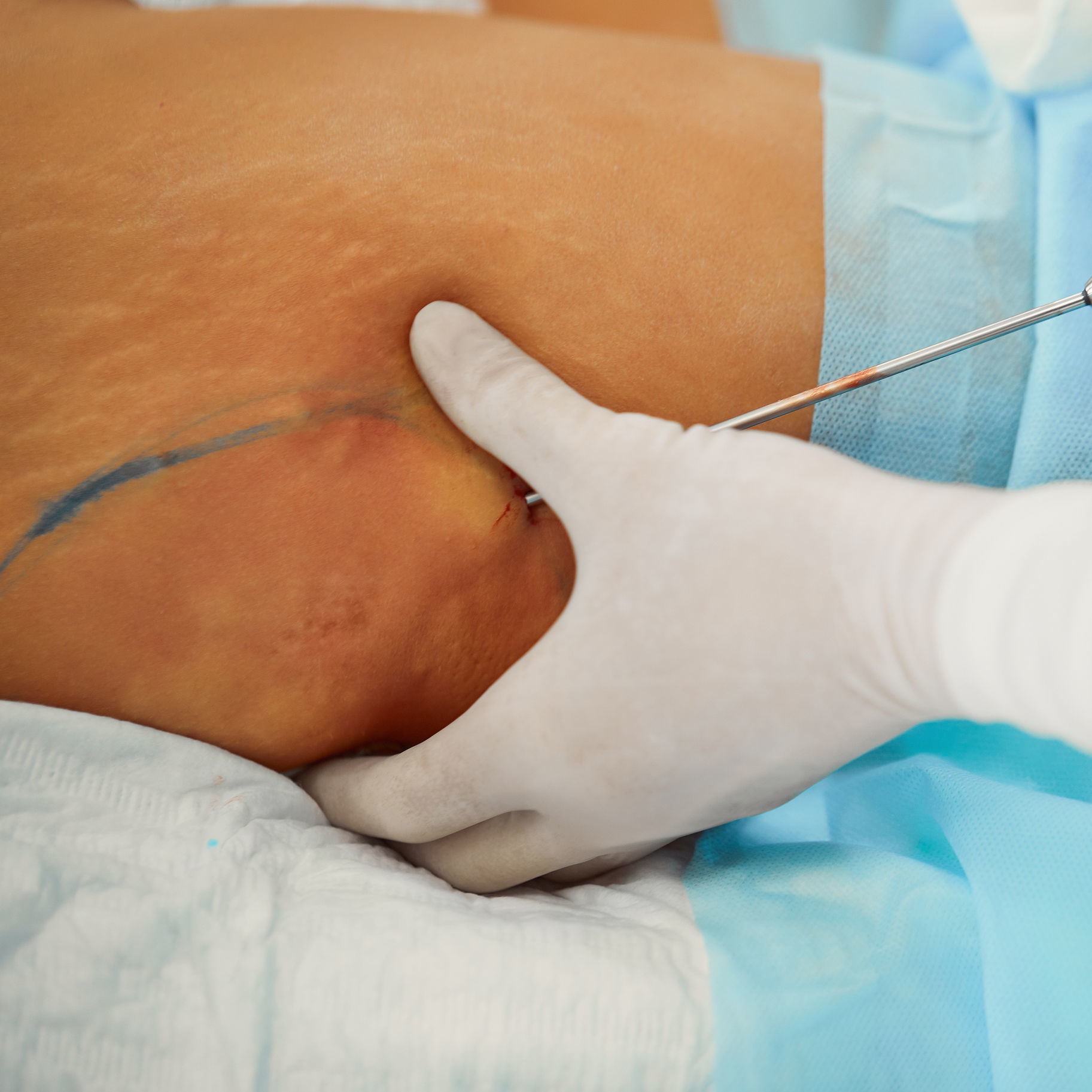 lipo2